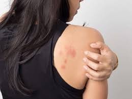 Un estudio afirma que las erupciones en la piel debe ser considerado como un síntoma de coronavirus | Internacionales