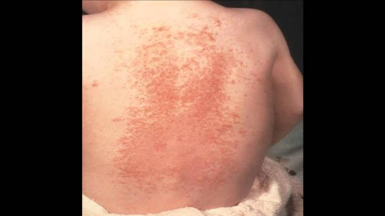 Histiocitosis: cuatro médicos argentinos participan en un seminario internacional sobre cáncer infantil | Actualidad