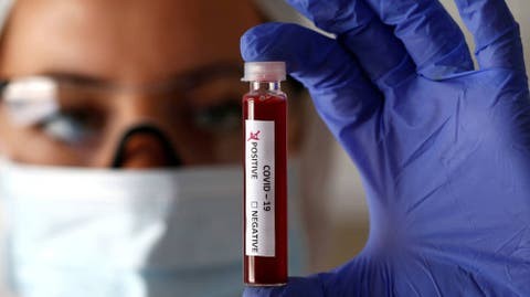 Coronavirus: un análisis en la sangre podría indicar que personas pueden tener un cuadro grave | Actualidad