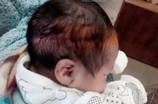 Un bebé recién nacido sufrió un corte de 15 centímetros en la cabeza durante la cesárea | Internacionales