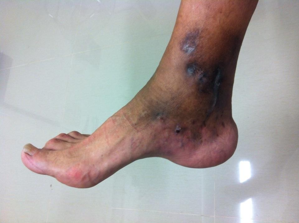 Micetoma: una enfermedad curable a la que llaman "muerte silenciosa" | Internacionales