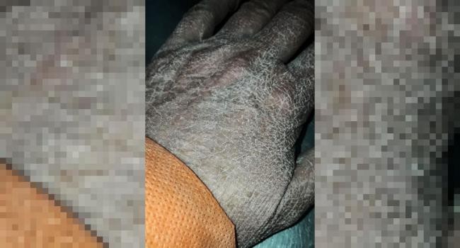 Se viralizó la imagen de la mano de una enfermera luego de horas de trabajo | Redes