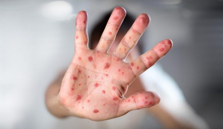 Esperan un gran brote de sarampión en el mundo el año que viene | Internacionales