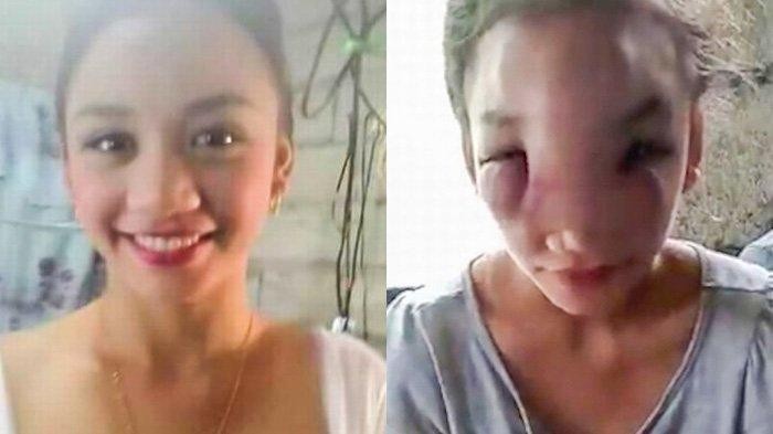 Una joven mamá pierde la visión por la expansión de su acné | Curiosidades