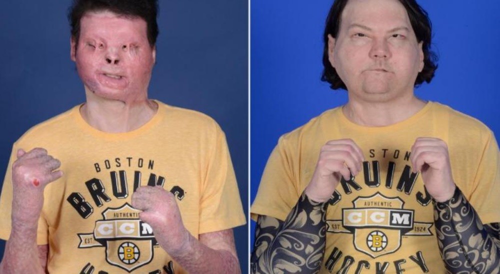 Primer trasplante de cara y manos en simultáneo | Actualidad