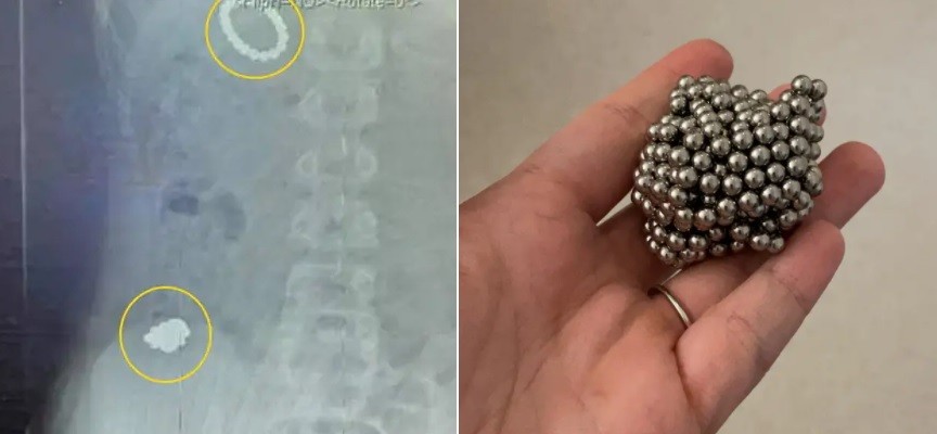 Operado de emergencia a un nene: se tragó más de 50 imanes para volverse magnético | Internacionales