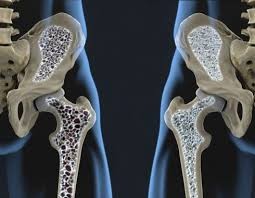 Utilizan nanotecnología para potenciar la eficacia de medicamento para la osteoporisis | Actualidad