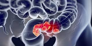 Día Mundial de la Prevención del Cáncer de Colon y Recto: prevención y control a partir de los 50 años para reducir casos | Actualidad