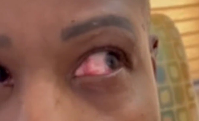 Se puso pegamento en el ojo al confundirse con las gotitas lubricantes | Internacionales