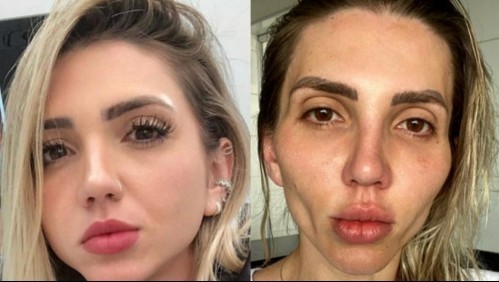 El drama de la tiktoker que se operó la cara: "Me convertí en una calavera" | Internacionales