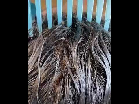 Video estremecedor: millones de piojos caminando en la cabeza de una nena | Internacionales