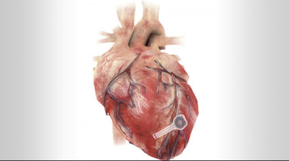 Crean un primer marcapasos biodegradable: desaparece cuando ya no es necesario | Internacionales
