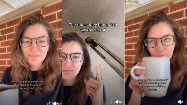 Fue al médico por un resfriado y le sacaron del oído un objeto que llevaba 22 años allí | Internacionales