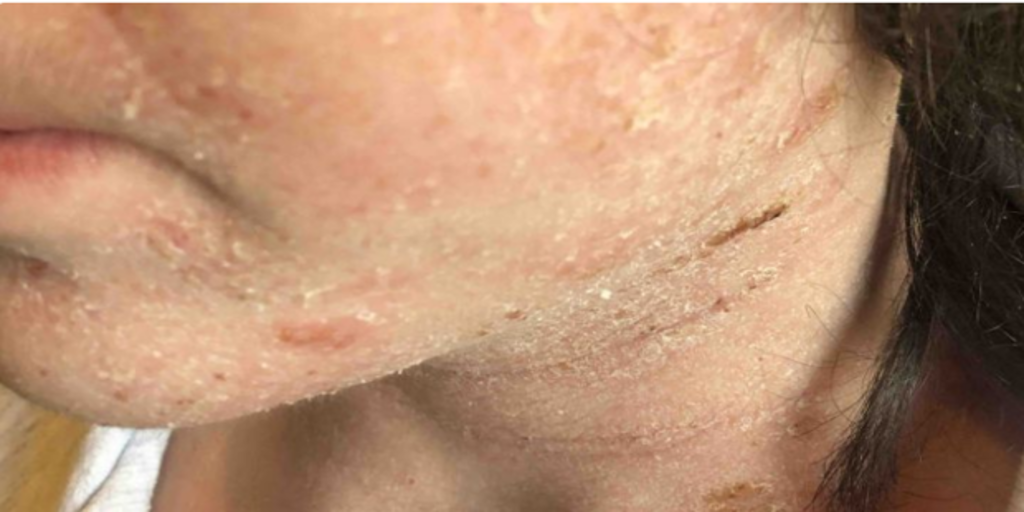 Tiene 14 años, sufre un eccema muy grave y pide entrar en coma porque ya no soporta el dolor | Internacionales