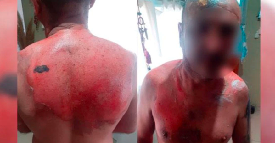 Un hombre fue atacado por su expareja con agua hirviendo | Actualidad