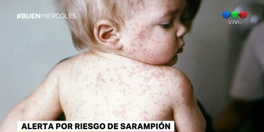 Emiten un alerta por el riesgo de que vuelva el sarampión a la Argentina | Actualidad