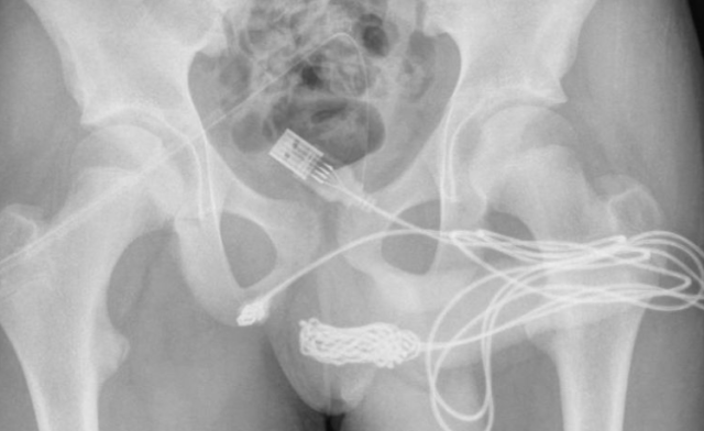 Un chico intentaba medir su pene y se le enredó un cable USB en la uretra: tuvieron que operarlo | Internacionales