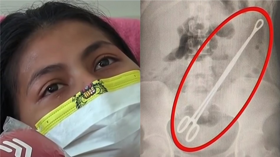 Vivió seis meses con una pinza de 20 centímetros en el vientre tras dar a luz | Internacionales