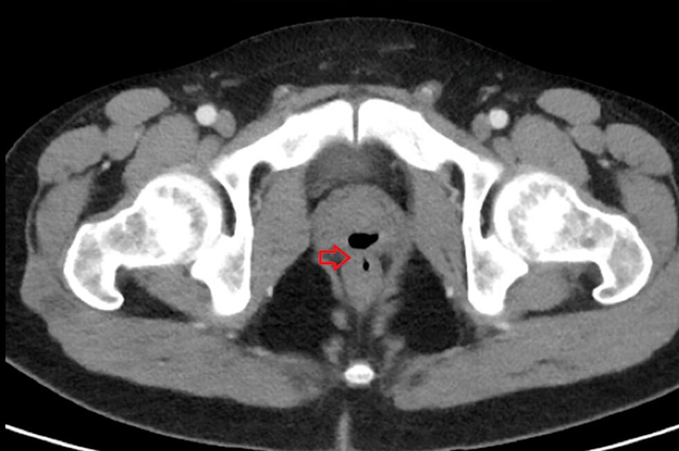 Médicos descubrieron que un hombre eyaculó por el ano durante más de dos años | Internacionales