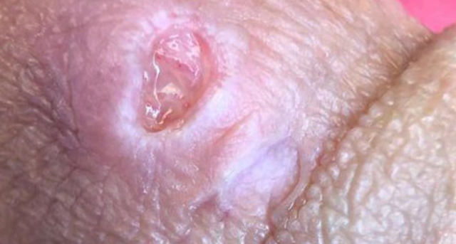 Suben los contagios en Reino Unido de una bacteria "comecarne" de transmisión sexual | Internacionales