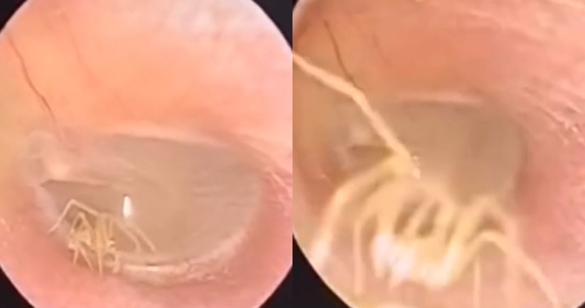 Video: así descubrieron una araña que anidó en el oído de una mujer | Internacionales