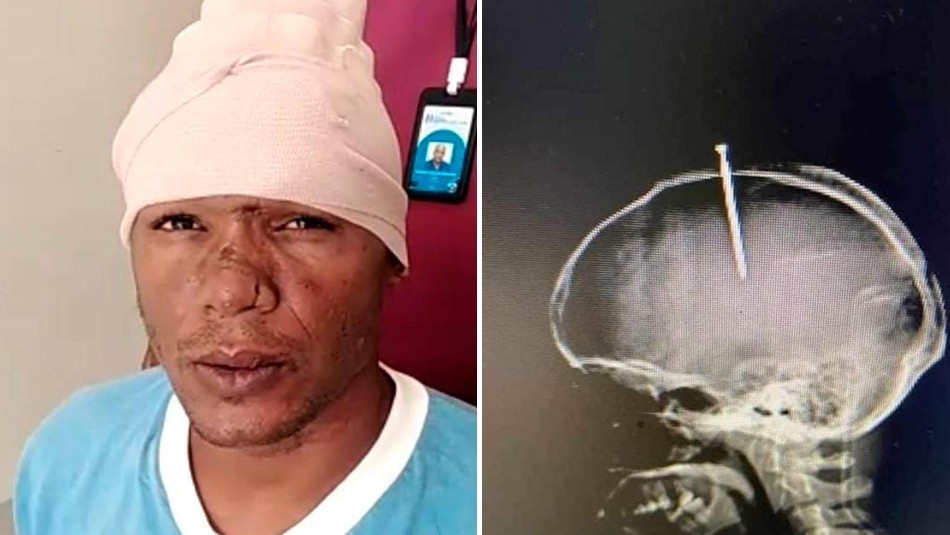 Alucinaba por las drogas y se le incrustó un clavo en la cabeza: los cirujanos le salvaron la vida | Internacionales