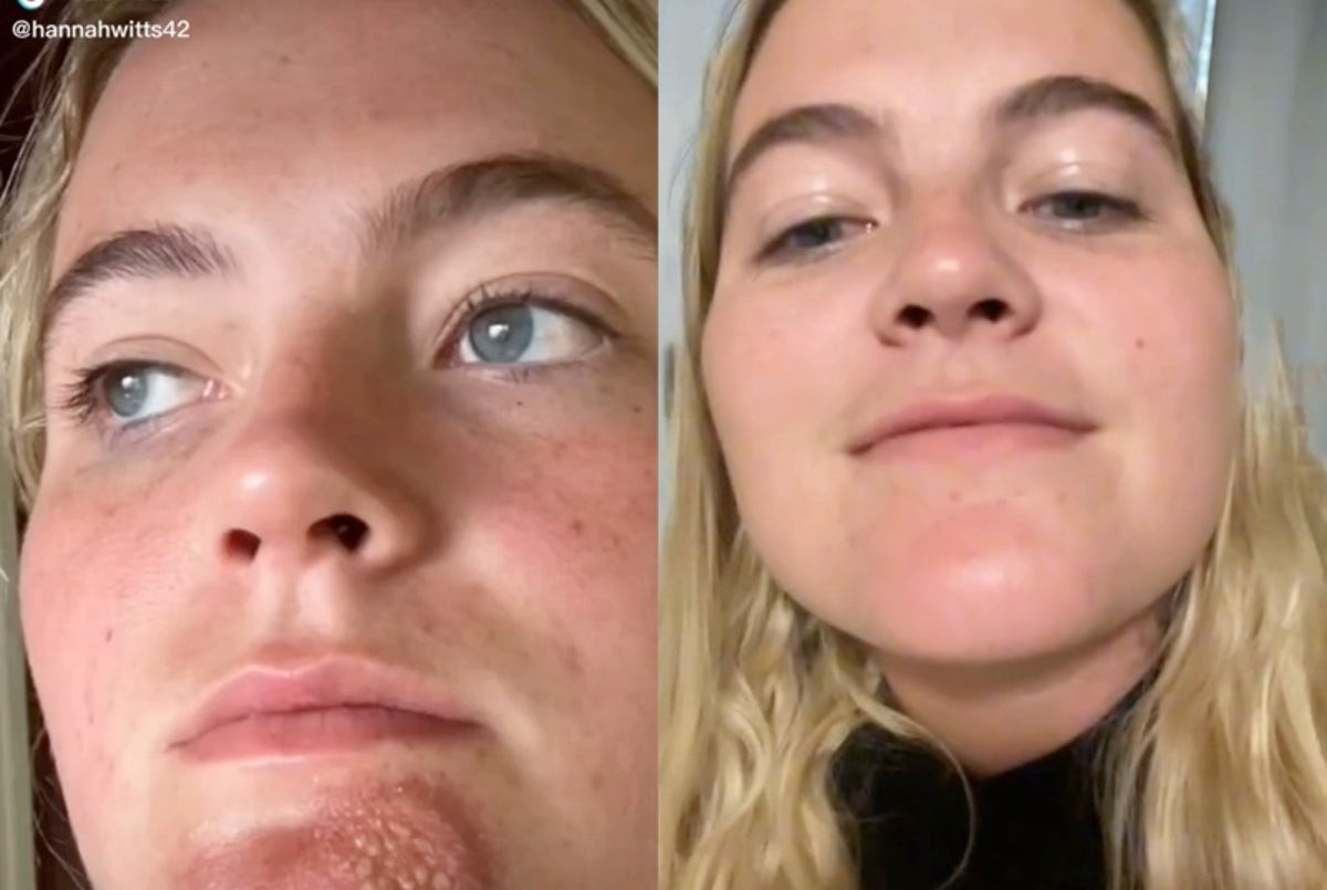 Una chica sufrió una grave infección tras besar a un hombre con barba | Internacionales