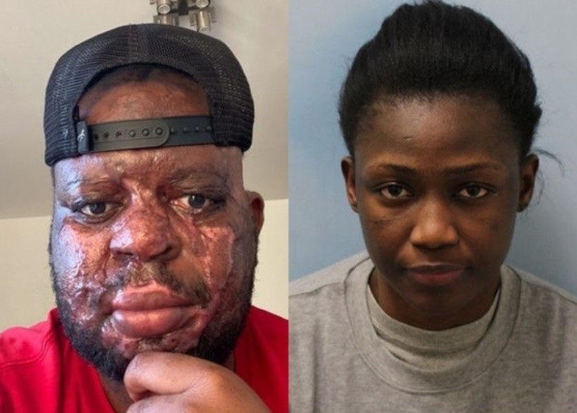 Le tiró ácido en la cara a su novio mientras dormía porque creía que le era infiel | Internacionales