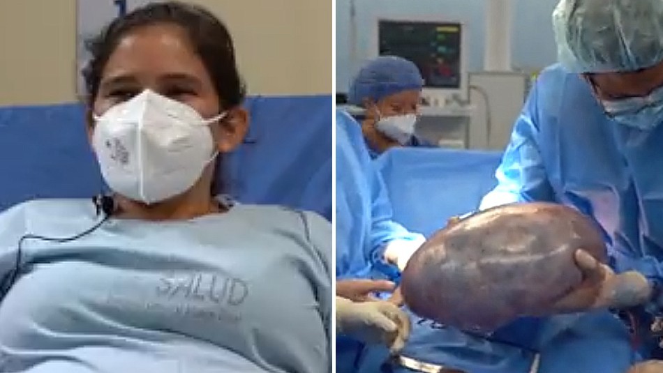 Le sacaron un tumor gigante de 6 kilos a una mujer: "Amenazaba su vida" | Internacionales