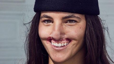 La modelo que se operó para recuperar el labio que perdió al ser atacada por un perro | Internacionales