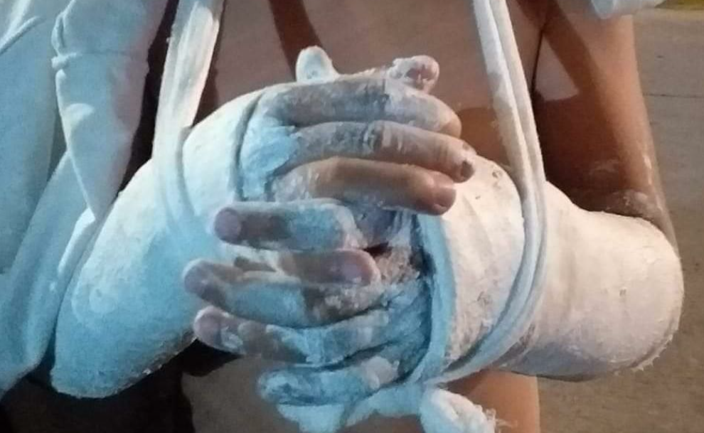 Se quebró las dos muñecas jugando en una plaza por las negligencias de la hamaca | Actualidad