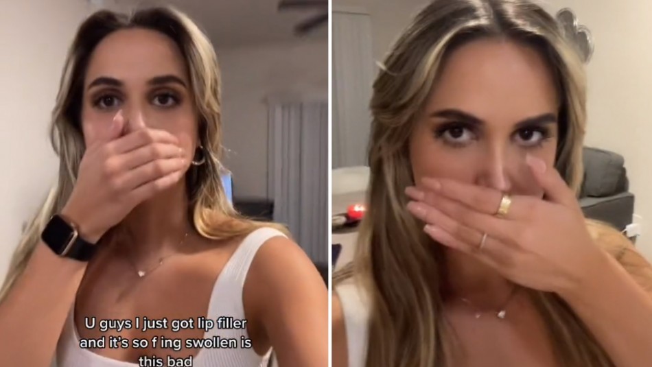 Video viral: influencer se operó los labios y el resultado asustó a sus seguidores | Internacionales