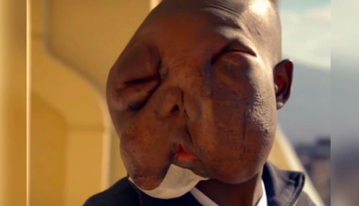 Padecía un extraño tumor que le desfiguró la cara, su mamá lo abandonó, encontró la cura y luce su nuevo rostro | Internacionales