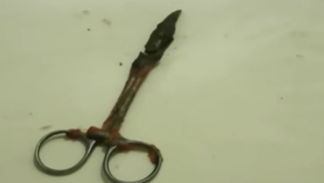 Le sacaron una tijera del estómago tras 20 años: sufría fuertes dolores abdominales | Internacionales