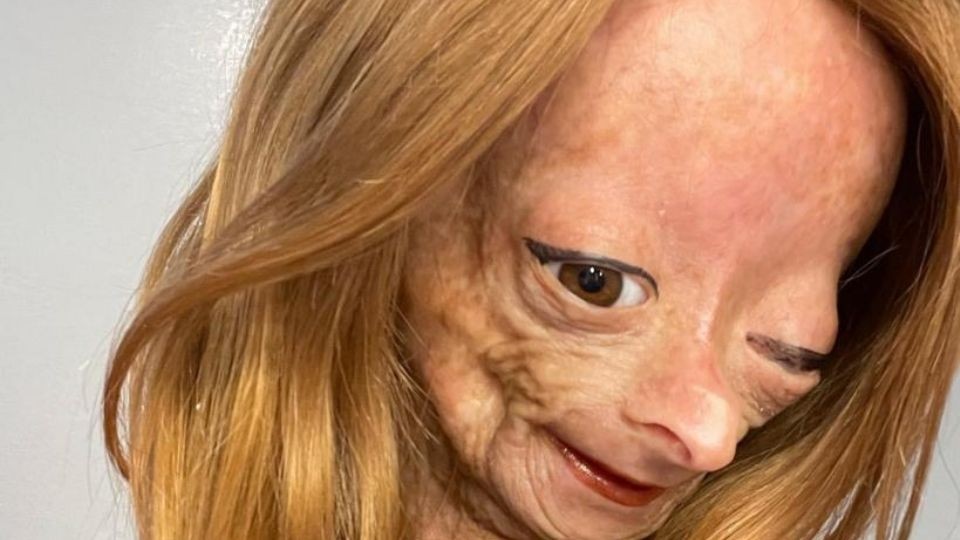Murió Adalia Rose, la youtuber que padecía envejecimiento prematuro | Internacionales