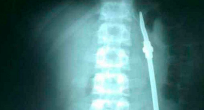 Un preso se tragó una bombilla, lo llevaron al hospital para operarlo y aprovechó para fugarse | Actualidad