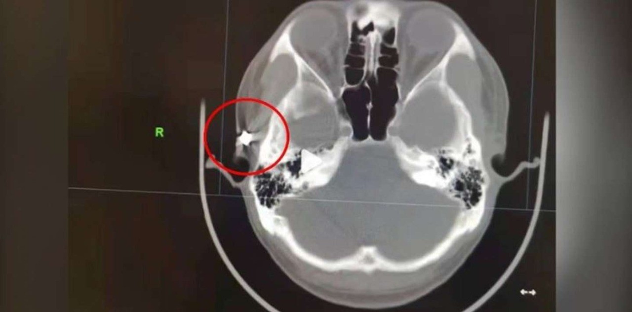 Pasó 20 años con una bala en el cráneo sin saberlo | Internacionales