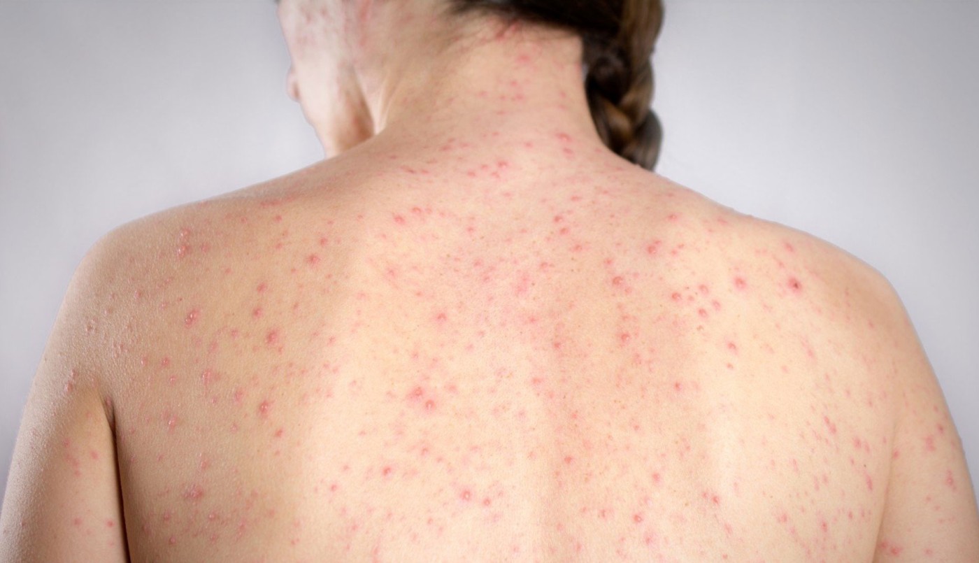 Alerta epidemiológico: El Ministerio de Salud informó un "posible caso" de sarampión en CABA | Actualidad