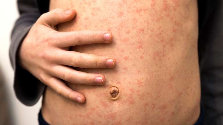 Sarampión: cómo se contagia, quiénes deben vacunarse, quiénes no y, ¿es mortal? | Actualidad