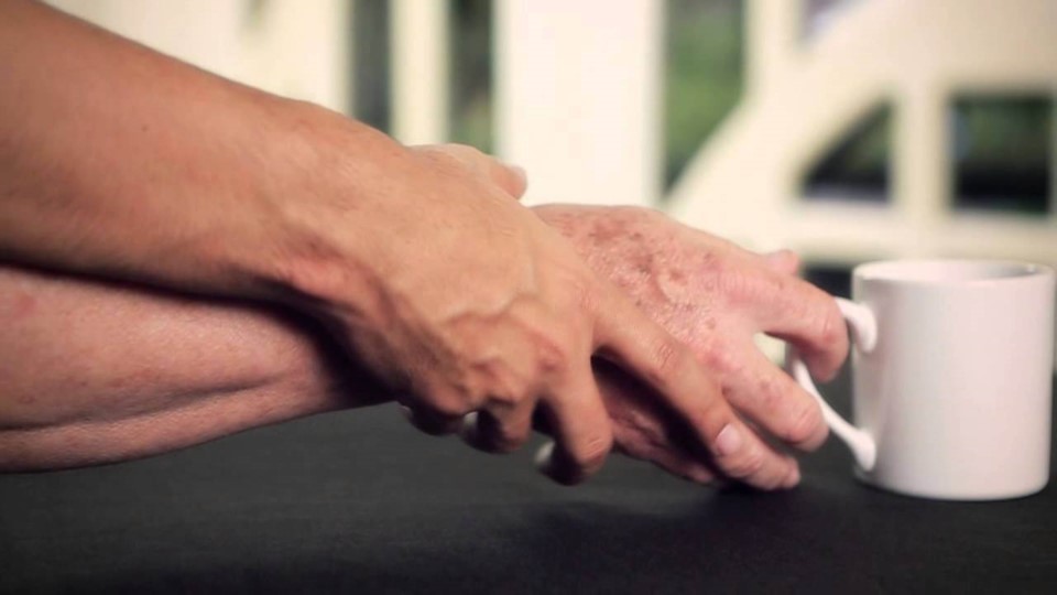 Unas cien mil personas viven en Argentina con Parkinson | Actualidad