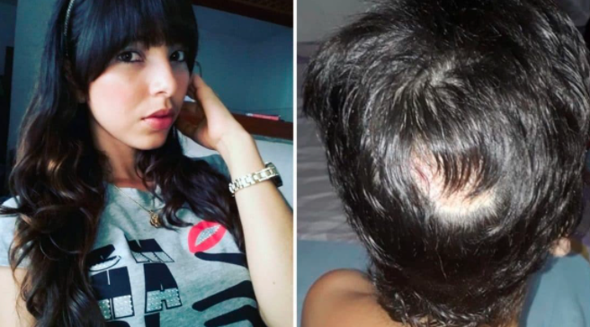 Su pareja le arrancó el cuero cabelludo para que ningún hombre volviera a mirarla | Internacionales