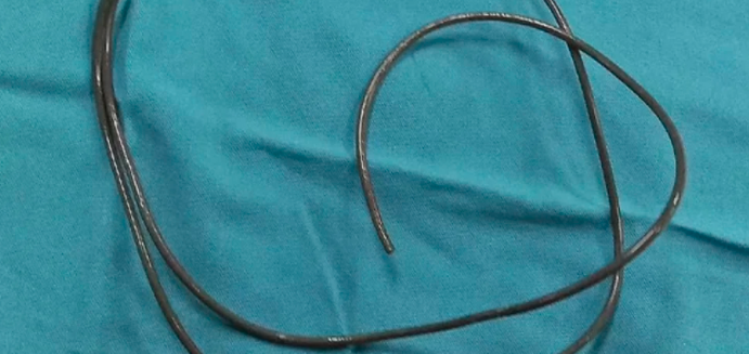 No podía orinar y lo que encontraron en su vejiga sorprendió a los médicos: “Lo hacía por placer sexual” | Internacionales