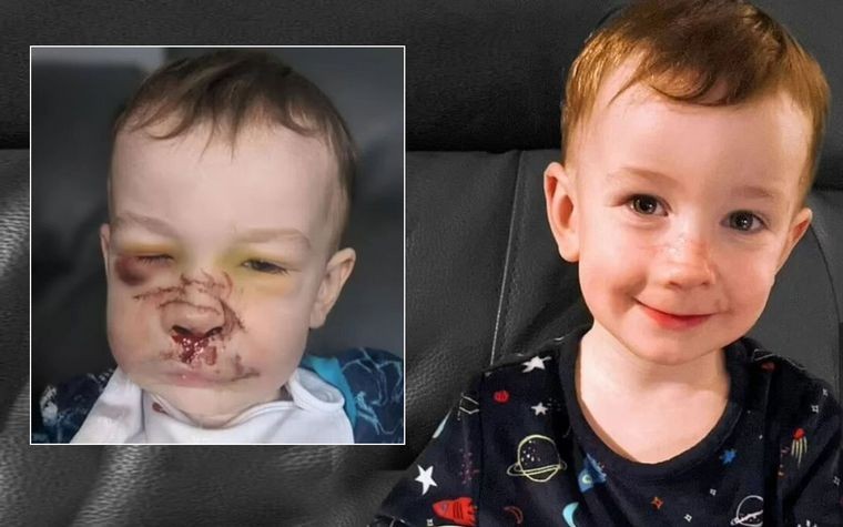 Un perro bull terrier le destrozó la cara de un mordisco a un bebé | Internacionales