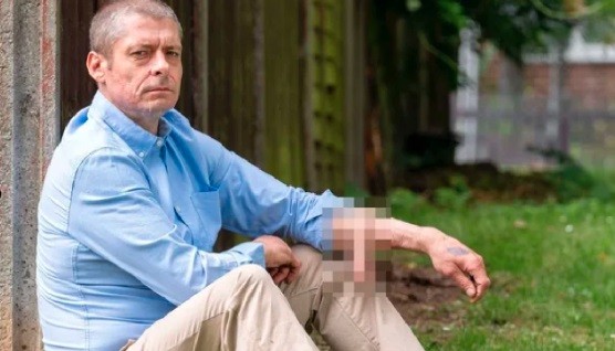 Vivió 6 años con un injerto de pene en el brazo y ahora se lo ubicaron en el lugar correcto | Internacionales