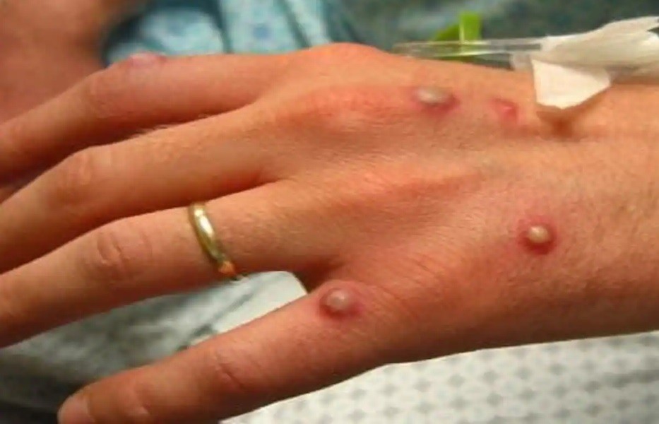 Piden que contactos estrechos de contagiados con viruela del mono se aíslen 21 días | Internacionales