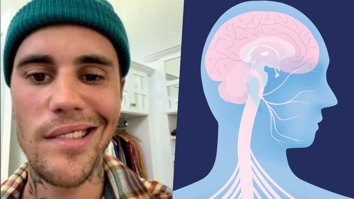 Qué es el Síndrome de Ramsay Hunt, la patología que le provocó parálisis facial a Justin Bieber | Actualidad