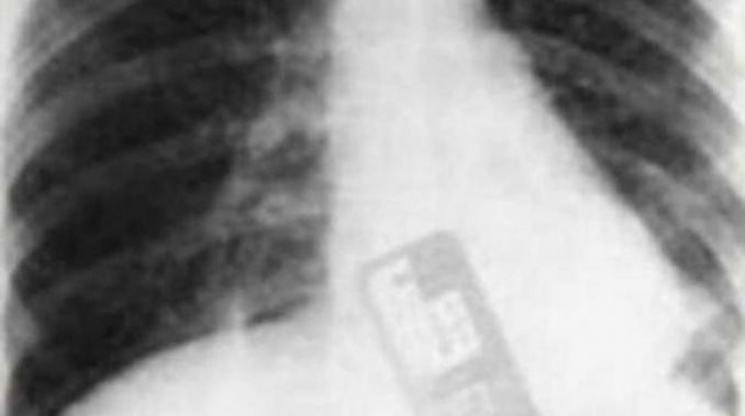 Un ginecólogo dejó su celular dentro del vientre de una paciente | Curiosidades