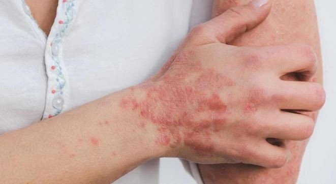 Viruela del mono: España ya superó los 5.000 casos confirmados | Internacionales