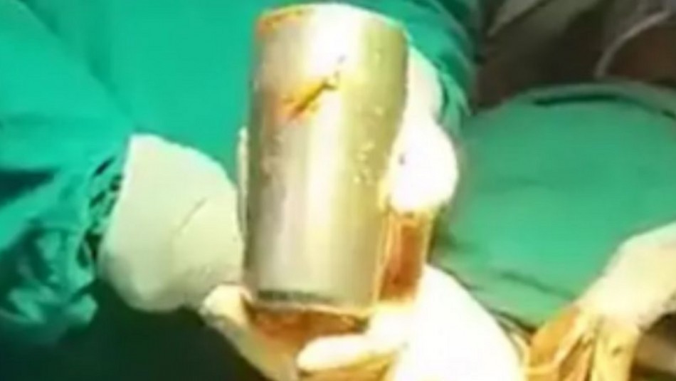 Fue al médico por dolores abdominales, lo operaron y le sacaron una copa de acero del estómago | Internacionales