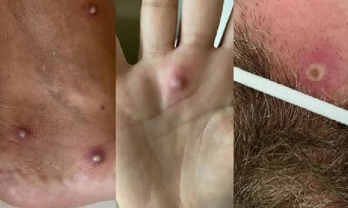 Primer caso en el mundo: fue al hospital con síntomas dio positivo de Covid, viruela del mono y VIH | Internacionales